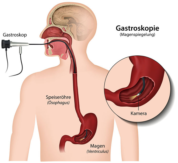 Schema Gastroskopie